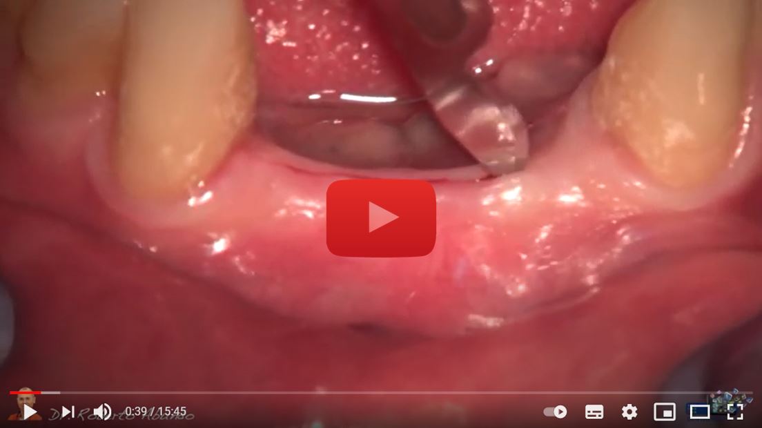 The use of OSSIX VOLUMAX matrix in lower incisor area
